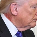 طبيب ترامب: الرئيس يستخدم علاجا وقائيا لطفح جلدي في رقبته