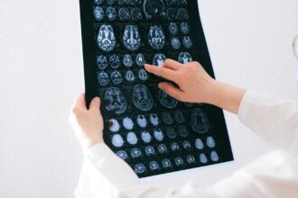 الوقاية من السكتة الدماغية تبدأ من نصائح بسيطة يمكن اتباعها بسهولة.