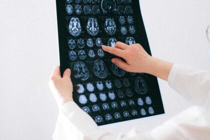 الوقاية من السكتة الدماغية تبدأ من نصائح بسيطة يمكن اتباعها بسهولة.