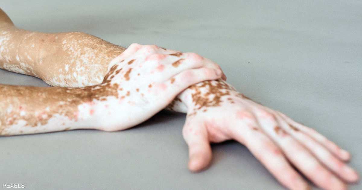 الباحثون يكشفون آلية جديدة لتطور البهاق ويساهمون في اكتشاف طرق علاجية محتملة.