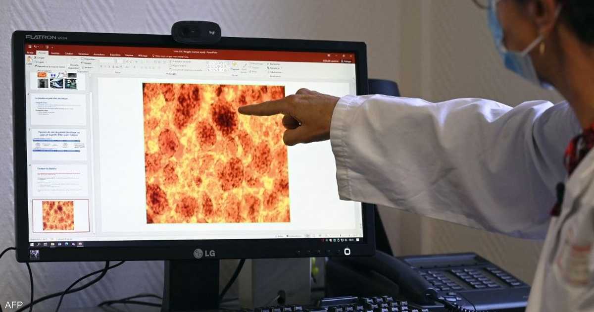دواء جديد يضاعف متوسط البقاء لدى مرضى سرطان البنكرياس النقيلي