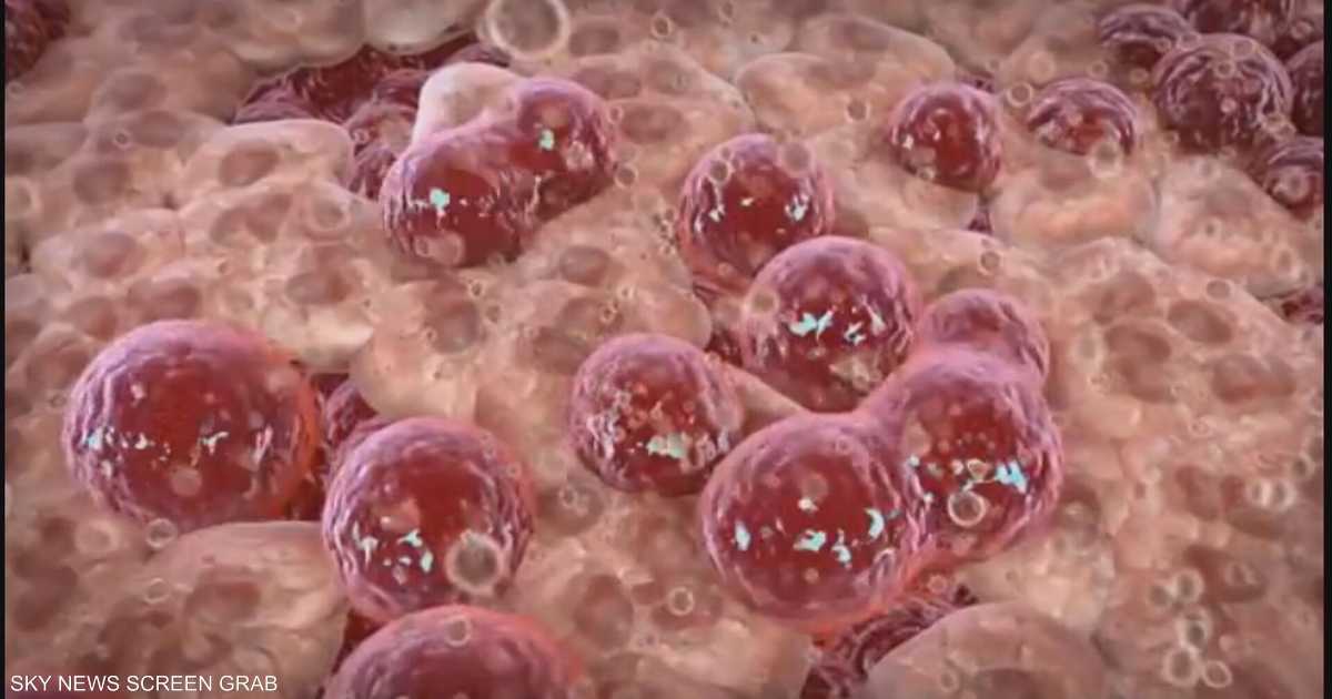تطوير جسيمات نانوية مغناطيسية لاستهداف وتدمير الأورام الصلبة