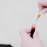 انخفاض إنزيمات الكبد يرتبط بزيادة خطر سرطان القولون المبكر لدى الشباب