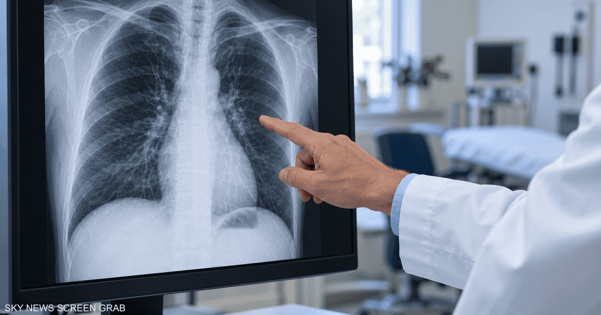 تركيبة دوائية جديدة تُطيل البقاء لمرضى سرطان الرئة المتقدم.
